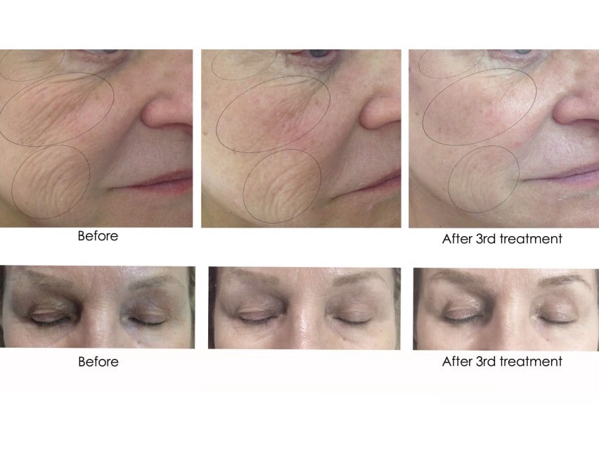 Carboxy Gel Treatment- Single Treatment